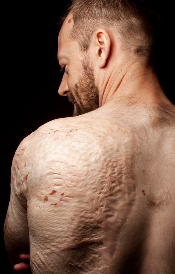 A man, facing away from the camera, with heavy scarring on his bare back.